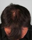Before Hair Transplant&nbsp;Front
